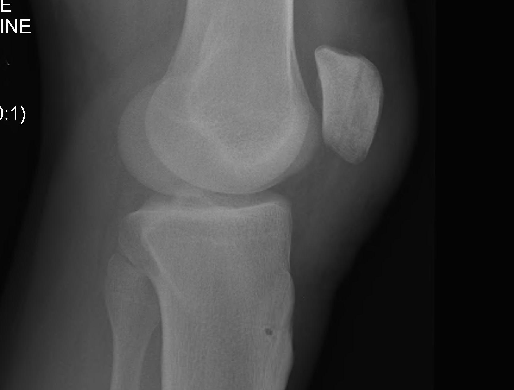 Patella Tendon Rupture Post Repair Intraosseous Sutures and Box suture